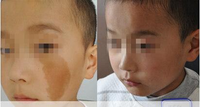 胎记什么时候治疗最合适_大成网_腾讯网