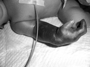 <em>新生儿</em>被皮筋绑衣袖致手臂缺血坏死 面临截肢