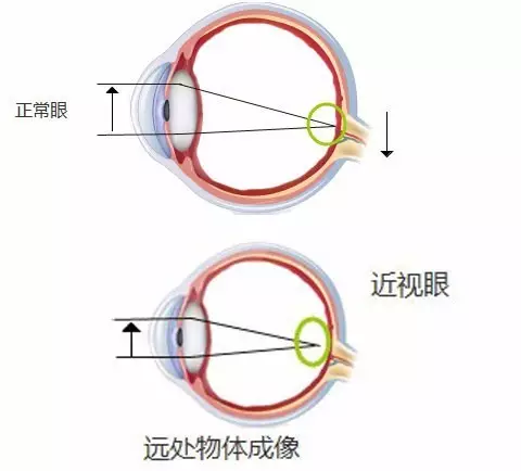 关于近视?来看看这些总结性的科普知识