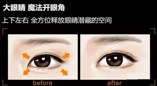 如何鉴定该不该开眼角 开内还是外_大成网_腾讯网