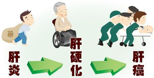 乙肝患者如何防止肝癌 这些预防方法赶紧收好