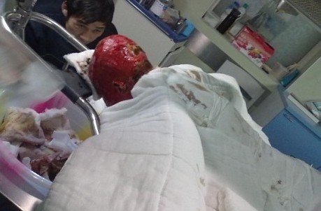 广元12岁男孩高烧晕倒在取暖器上 严重烧伤