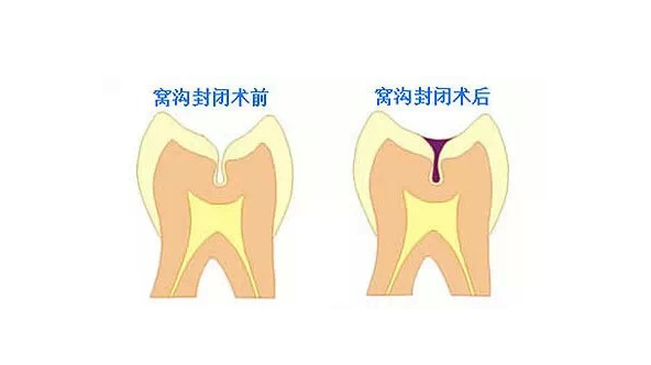 儿童牙齿窝沟4颗窝沟封闭