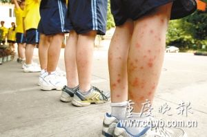 蚊子咬一口皮肤就溃烂 夏季气温高皮肤病增一