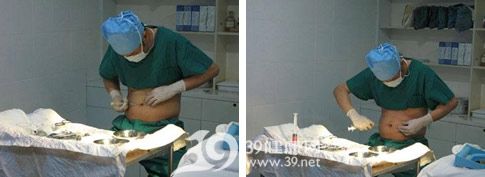 左图:给肚脐麻醉;右图:肚脐抽脂中