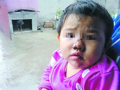 惨!工厂大藏獒撕裂女童鼻子缝15针可能破相_重