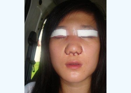 女子自拍割双眼皮 隆鼻全过程(图)_健身美容本