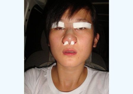 女子自拍割双眼皮隆鼻全过程(图)_健身美容本
