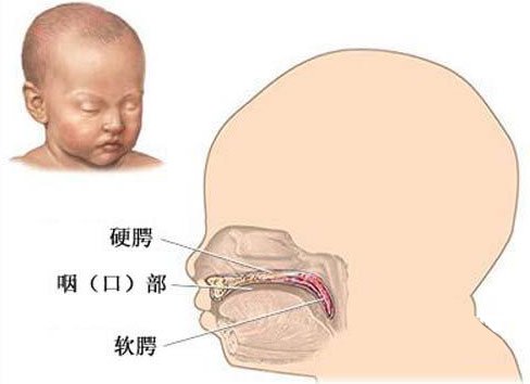 腭裂则是在口腔