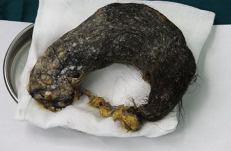 吃<em>头发</em>女孩成功<em>手术</em>+胃内取出数万根<em>头发</em>吓死