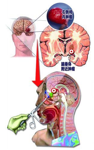 切下大脑里鹅蛋大垂体瘤