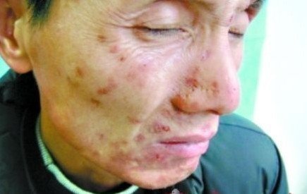 吸毒男子患寄生虫妄想症瘙痒难忍抓烂脸皮