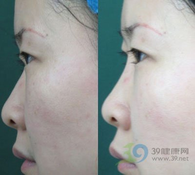 注射隆鼻_misko隆鼻_微晶瓷隆鼻多少_综合隆鼻 - 黑马 ...