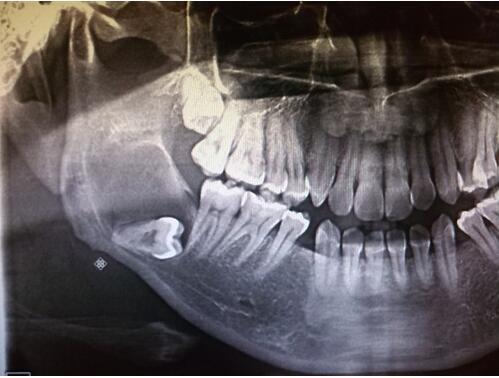 重庆智齿什么时候可以拔除