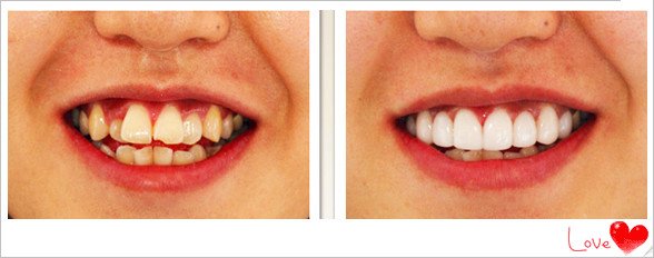 重庆牙科:成人牙齿矫正可能出现的问题