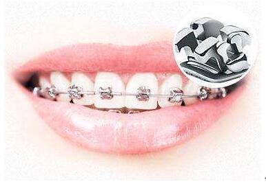 调查称近5成人需要矫正牙齿 查查你需要箍牙吗_大渝网_腾讯网