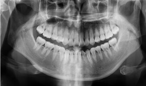 10年后70%的正畸患者需要重新矫正牙齿?