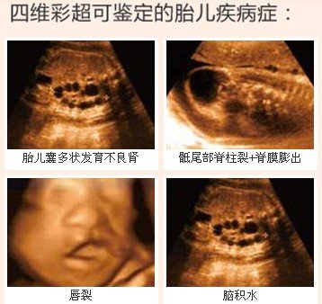 四维彩超对胎儿畸形,胎儿骨骼发育异常