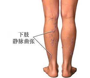 你不得不知的“蚯蚓腿”的那些事