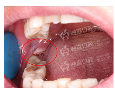 智齿发炎肿痛怎么办