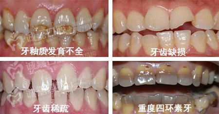 诚嘉全瓷美牙冠 360°为您打造靓白好牙_大渝网_腾讯网