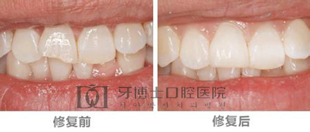 重庆为什么选择全瓷美牙冠修复牙齿