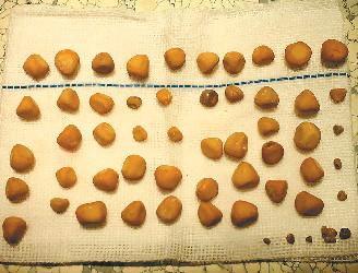 ���Ӿ�������ʹ ȥҽԺ�������ȡ��143���ʯ