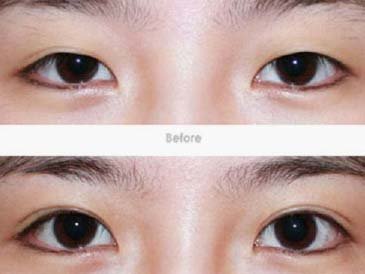 重庆<em>女孩割双眼皮</em>选择埋线好嘛?_大渝网_腾讯