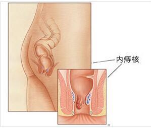 重庆医博肛肠医院:内痔百科