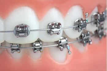 重庆牙科医院牙齿矫正价格是多少?