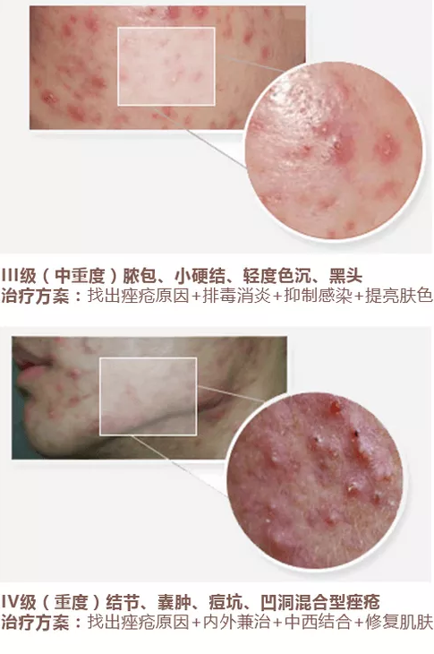 少年脸如癞蛤蟆挤痘险毁容 请不要随便扣痘
