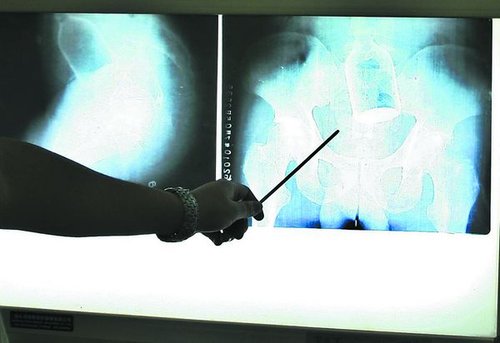 输液瓶塞进他肛门 肠管破裂腹腔内出血 险!_重