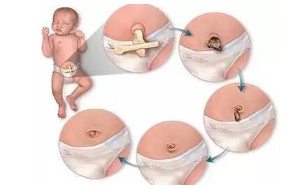 新生儿肚脐护理 6个常见错误别犯