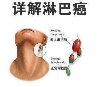 淋巴瘤gdp_淋巴瘤早期症状图图片