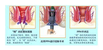 外痔的发病原因都有哪些?重庆医博肛肠