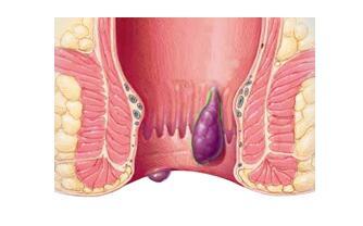 痔疮为什么不会自己好呢?