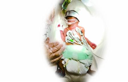 怀孕仅23周意外流产 重庆660克早产筷子宝宝