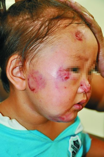 宝宝入托儿所第一天 惨遭男童咬伤(图)