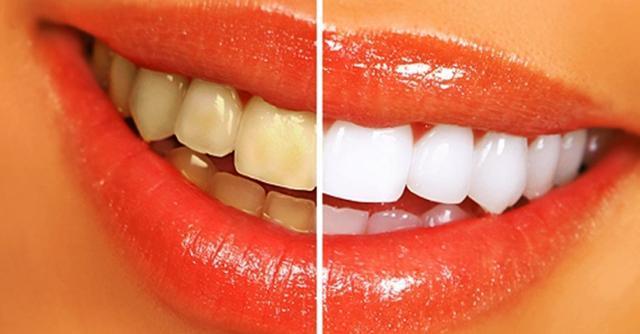 牙黄牙垢很难看 用这些简单方法牙齿很快变白