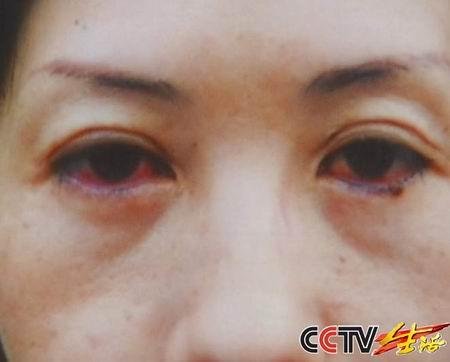 女子美容院纹眼线感染结膜炎