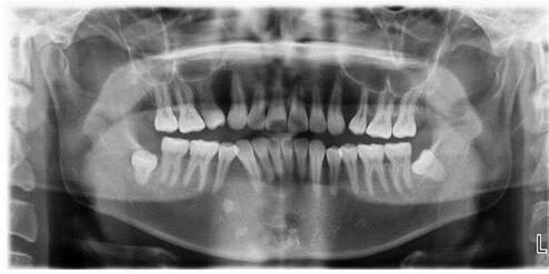 什么时间开始长智齿 141079022.jpg