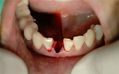 重庆拔牙对其他牙齿有影响吗