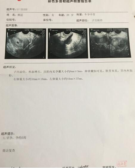 一开始因为太迫切的想要怀孕,所以确诊病情后,主要以达英35 促排卵