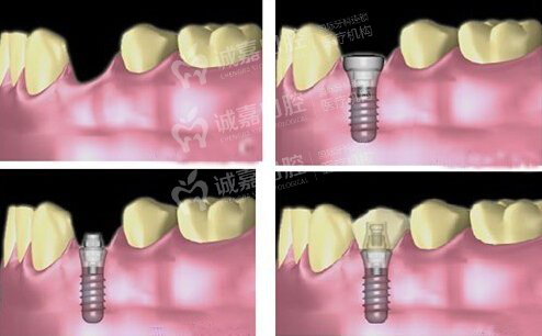 老人牙齿掉了怎么办