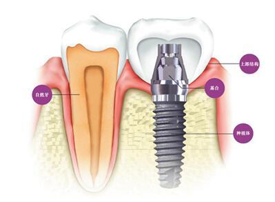 种植牙的六大好处