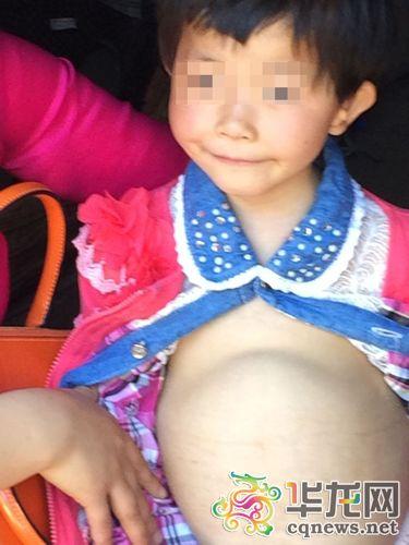 6岁女童整天戴着尿不湿 <em>肚子</em>胀得像大皮球_大