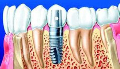 牙种植要多少钱
