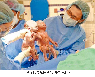 生命奇迹 美罕见单羊膜双胞胎女婴牵手出生