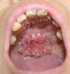 口腔癌的常见病因有哪些?
