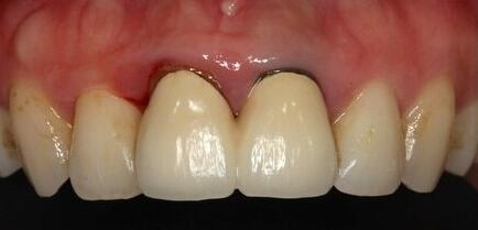烤瓷牙导致牙龈变黑的原因